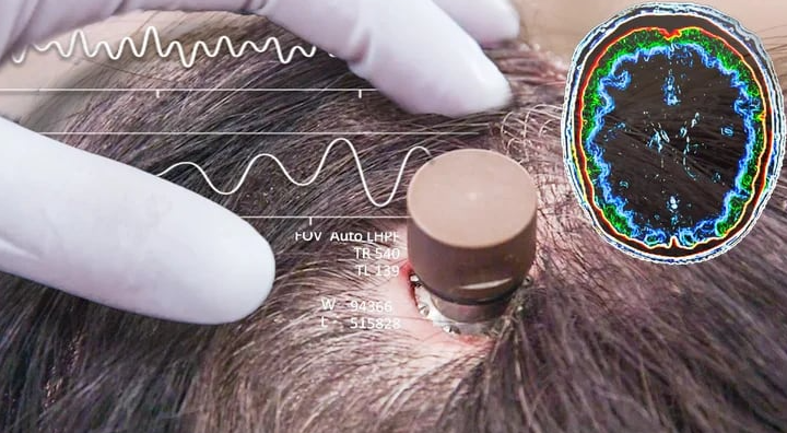 Un Salto Revolucionario en la Tecnología Cerebral: Neuralink y el Control Mental de una partida de Ajedrez